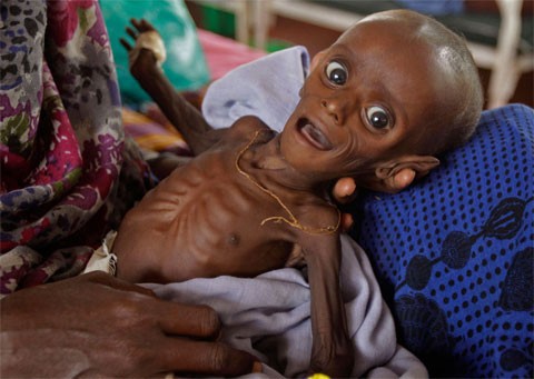 Mihag Gedi Farah, một em bé 7 tháng tuổi bị suy dinh dưỡng chỉ nặng 3,4 kg, được mẹ bế tại một bệnh viện dã chiến của Ủy ban Cứu trợ Quốc tế (IRC), tại thị trấn Dadaab, Kenya, hôm 26/7. Liên Hợp Quốc đã phải tuyên bố nạn đói khủng khiếp hoành hành tại Kenya và nhiều quốc gia châu Phi khác. Ảnh: AP